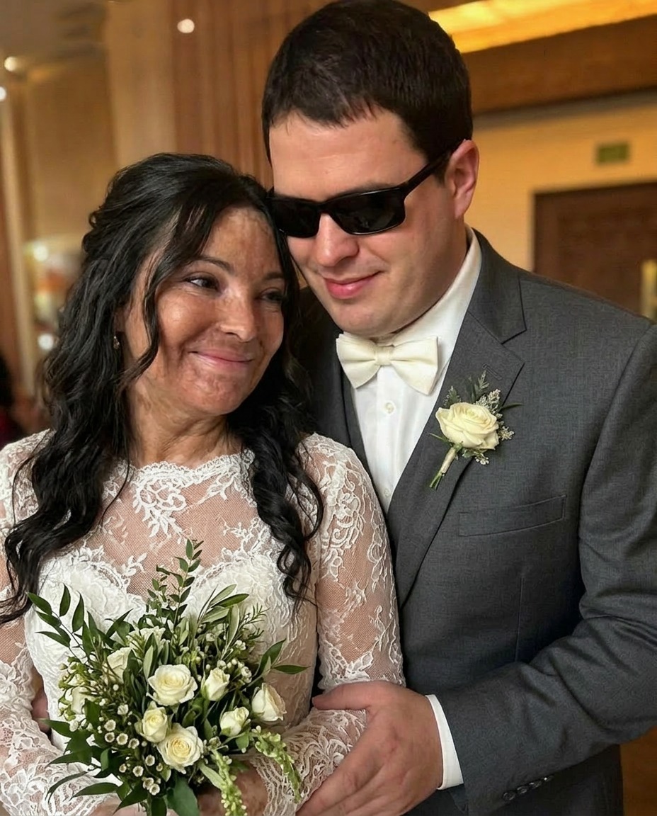 I Married a Blind Man So He’d Never See My Scars – On Our Wedding Night, He Said, ‘You Need to Know the Truth I’ve Been Hiding for 20 Years’